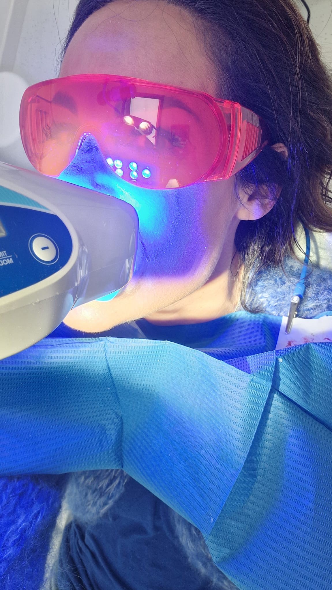 Risultato sbiancamento dentale